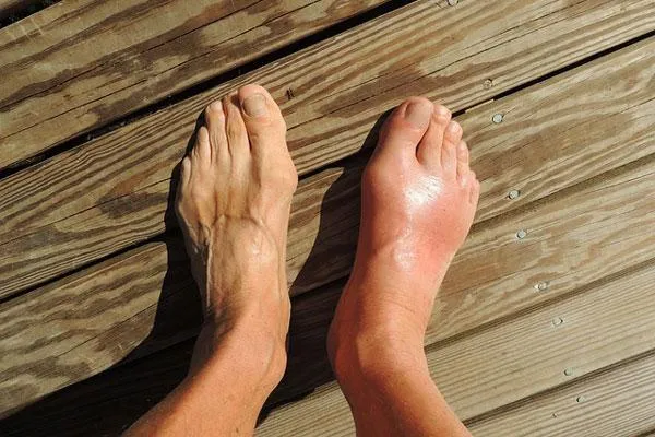 Understanding the Sensation of Gout Pain