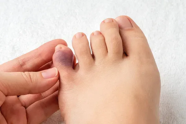 How Serious Is a Stubbed Toe?