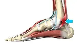Pain Localization of Tarsal Tunnel Syndrome