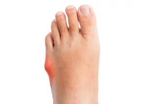 Bunionette Treatment