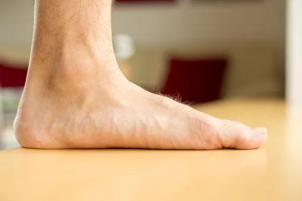 Causes and Implications of Flat Feet