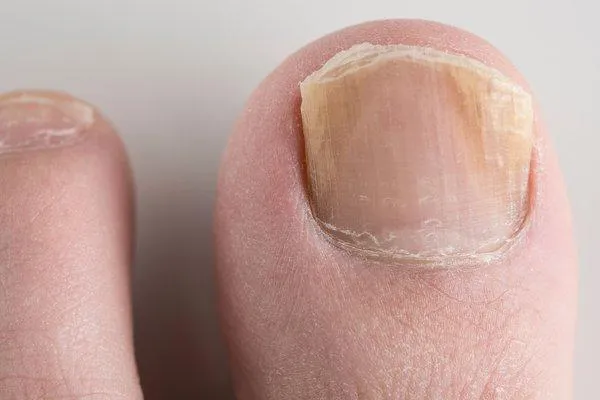 Causes of Thick Toenails