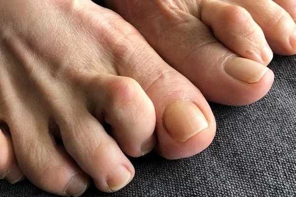 What Exactly is a Hammertoe?