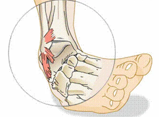 Ankle Sprains: From RICE to Recovery