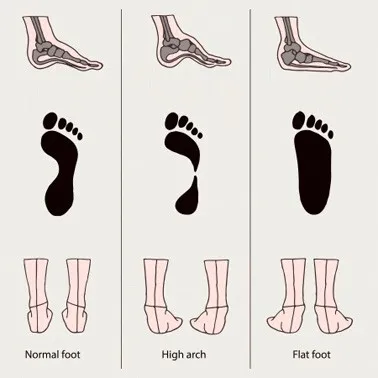 Flat Feet and High Arches: Finding Support for Every Foot