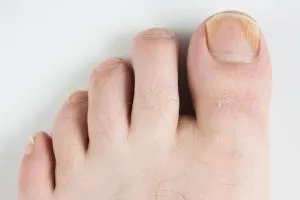Battling Fungal Nails: Understanding Topical and Oral Medications
