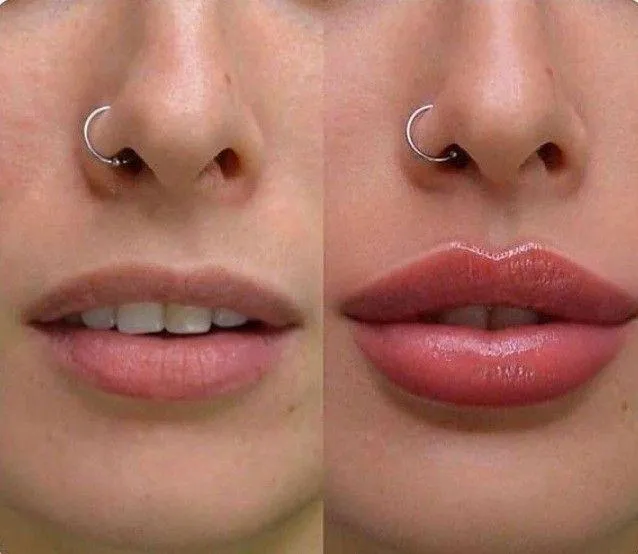 Lip Filler Raleigh NC
