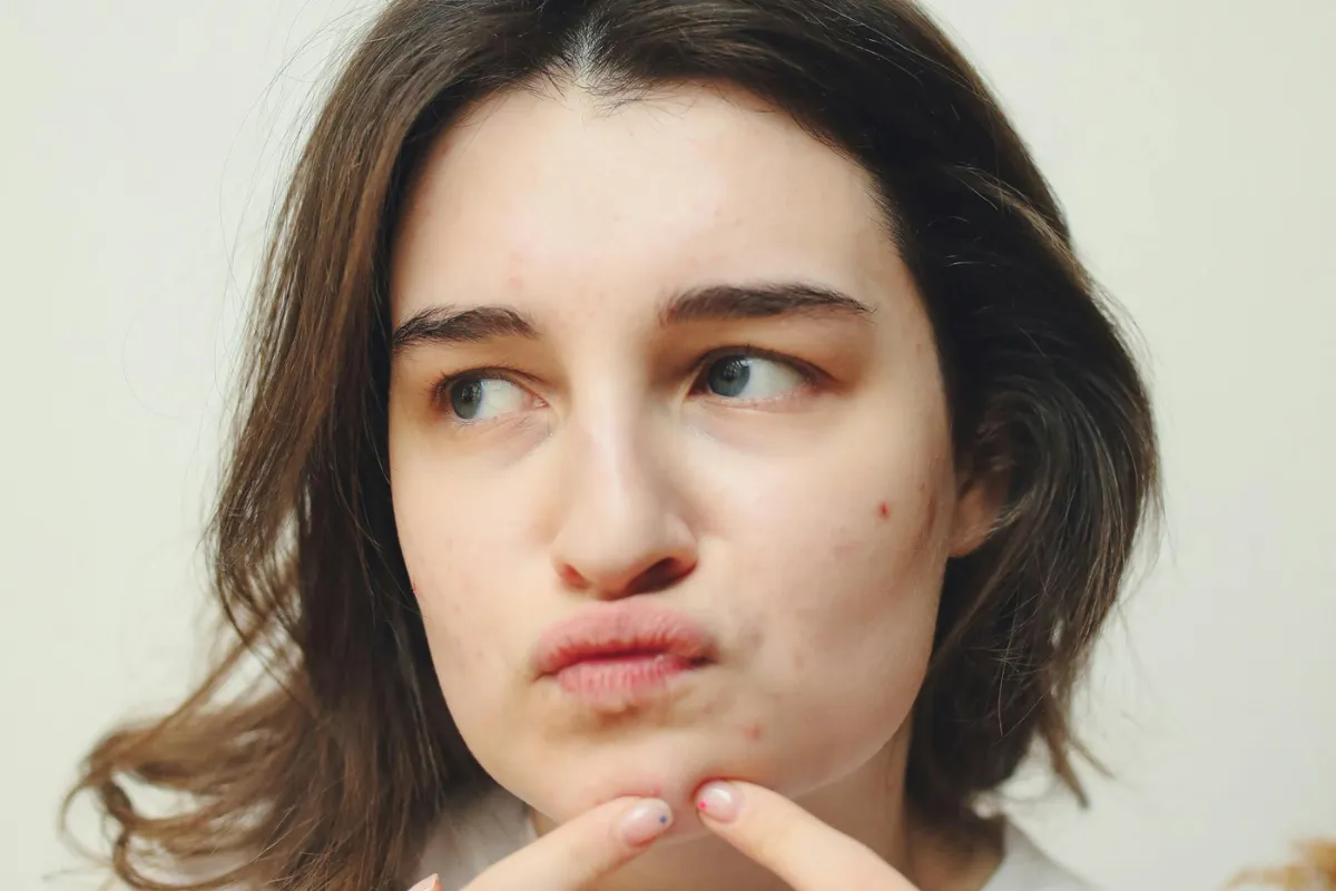Acne Facial