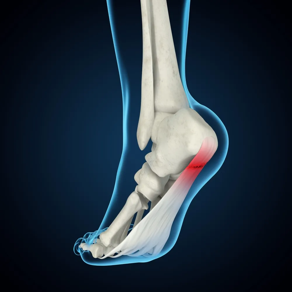 Heel Pain, Plantar Fasciitis