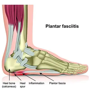PLANTAR FASCIITIS! TIPS, TRICKS AND A TEST