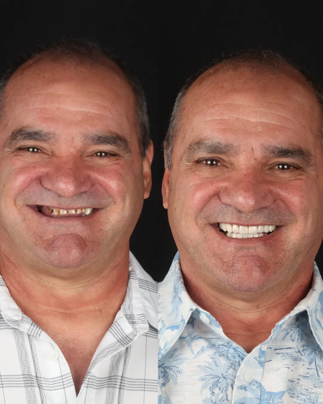 /blog/benefits-of-dental-implants