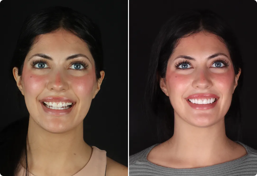 ¿Qué son las carillas dentales?
