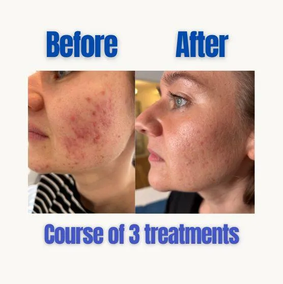 Plinest Skin Booster at Blue Bird Aesthetics Worthing