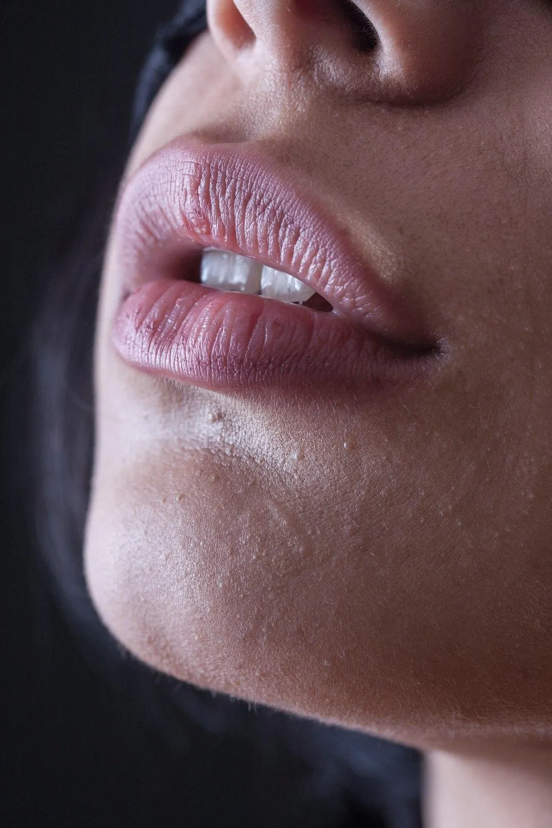 Dermal Filler Price Ranges in Worthing: What to Expect