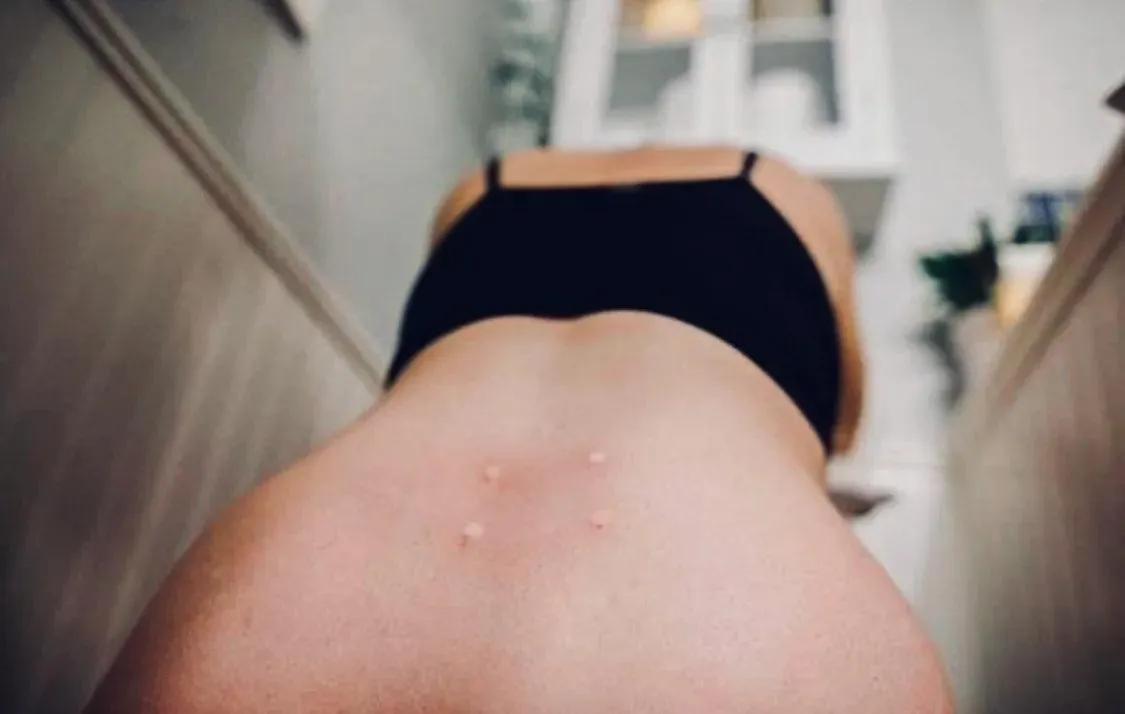 Sterile Water Injections: The Underrated Pain Relief in Labour