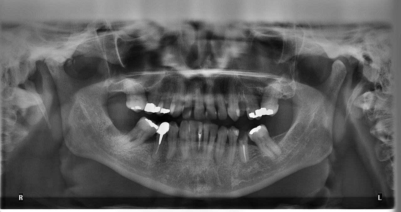 Dental X-Rays: Why They’re Essential for Early Detection and Oral Health