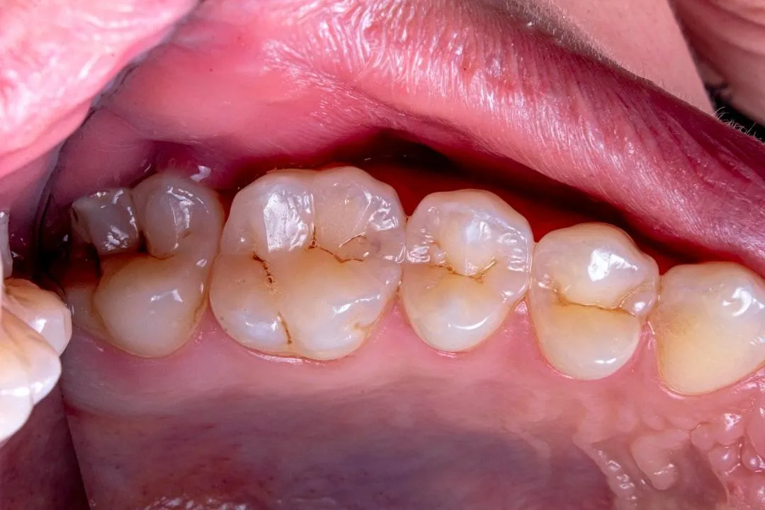 Plaque: What It Is and How It Harms Your Teeth and Gums