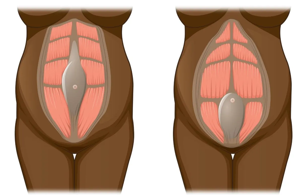 Abdominal wall separation