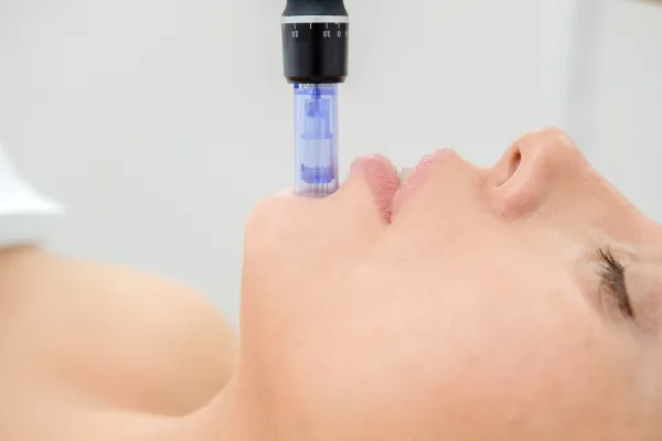 5 Benefits of Micro-Needling for Your Skin