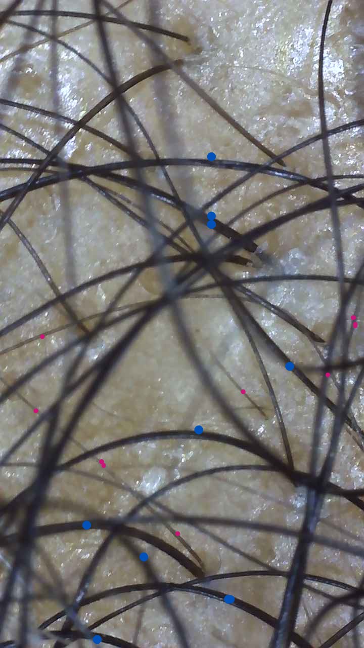 miniaturized and terminal scalp hair