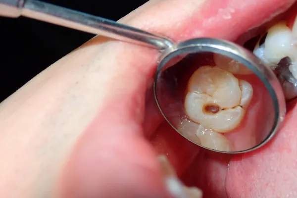 Parent's Guide: How to Prevent Cavities in Baby Teeth