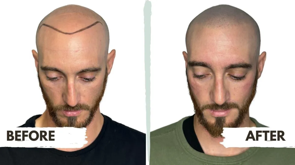 Scalp Micropigmentation Treatment for Hair Loss and Hairline Restoration