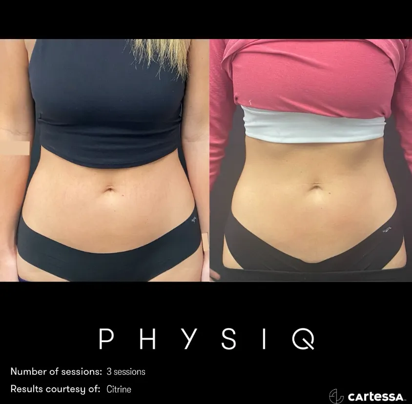 After 3 Sessions of Body Contouring with PHYSIQ