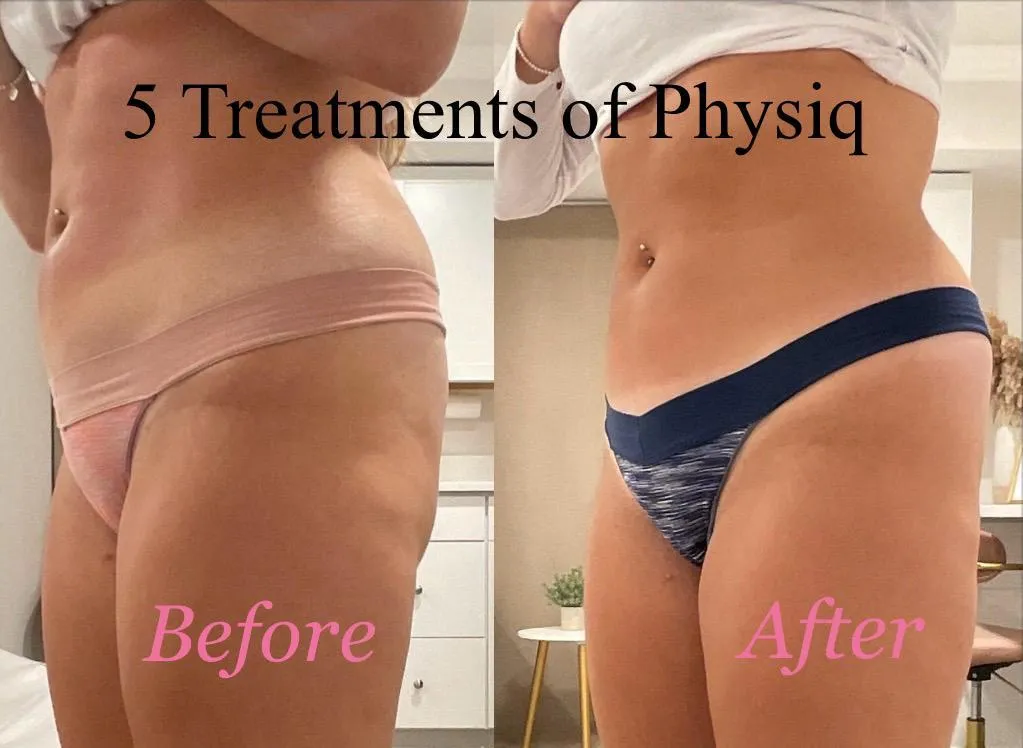 After 3 Sessions of Body Contouring with PHYSIQ