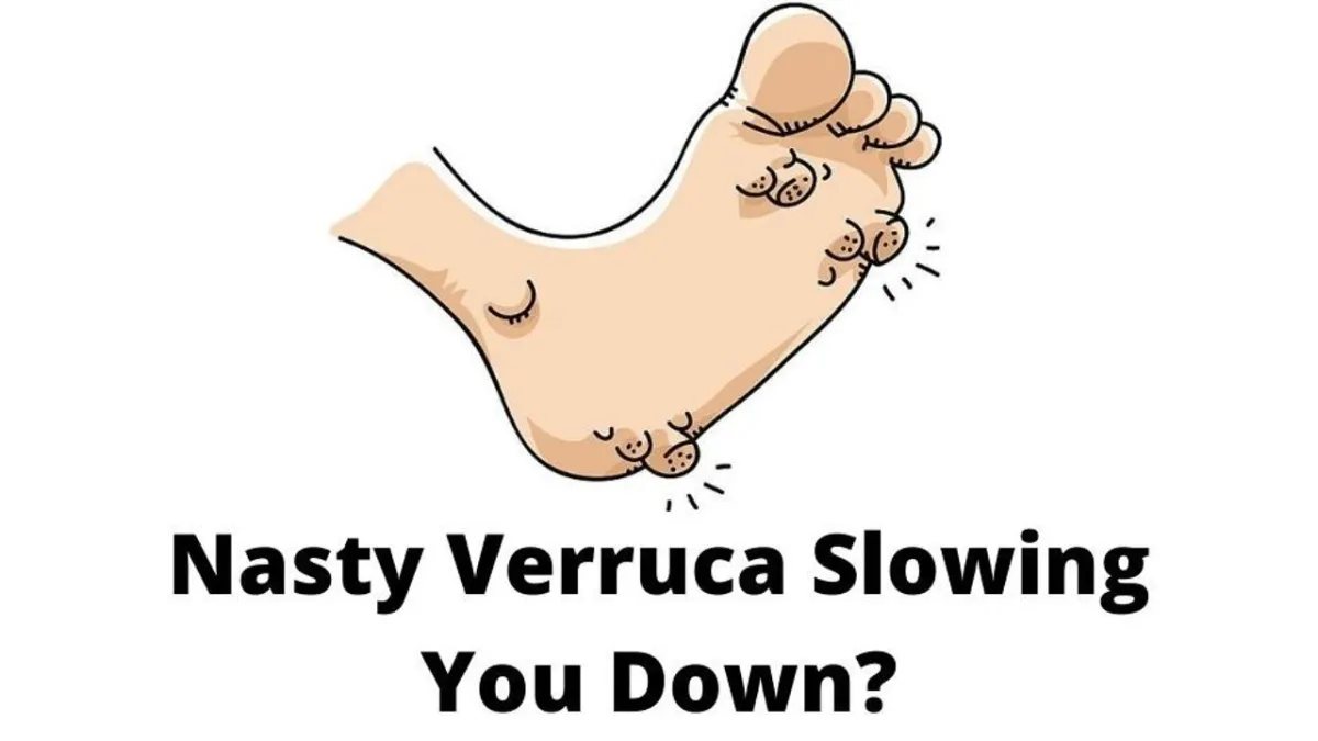 Verruca Achilles Foot Clinic Cork