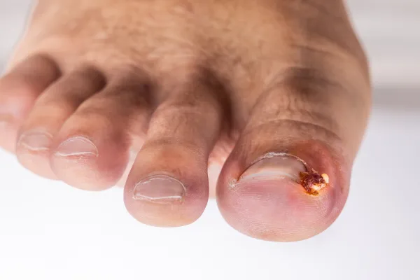 inflamed ingrown toenail