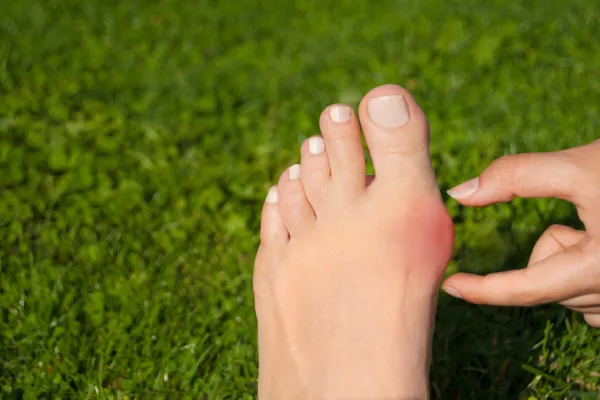bunion on womans foot on grass
