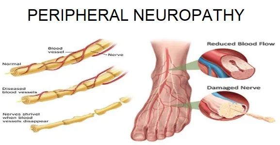 neuropathy, neuropathy treatment, small fiber neuropathy, large fiber neuropathy, peripheral neuropathy
