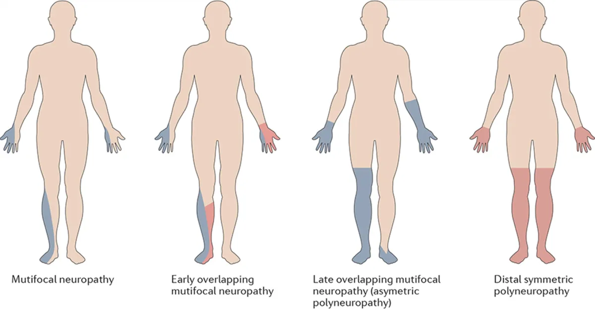 multifocal neuropathy, neuropathy, peripheral neuropathy, diabetic neuropathy, neuropathy treatment