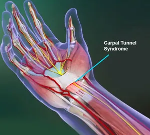 carpal tunnel,guyon syndrome, neuropathy