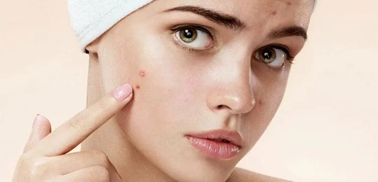 HƯỚNG DẪN CÁCH NẶN MỤN HIỆU QUẢ KHÔNG ĐỂ LẠI SẸO RỖ, LÕM, THÂM MỤN VÀ VIÊM DA