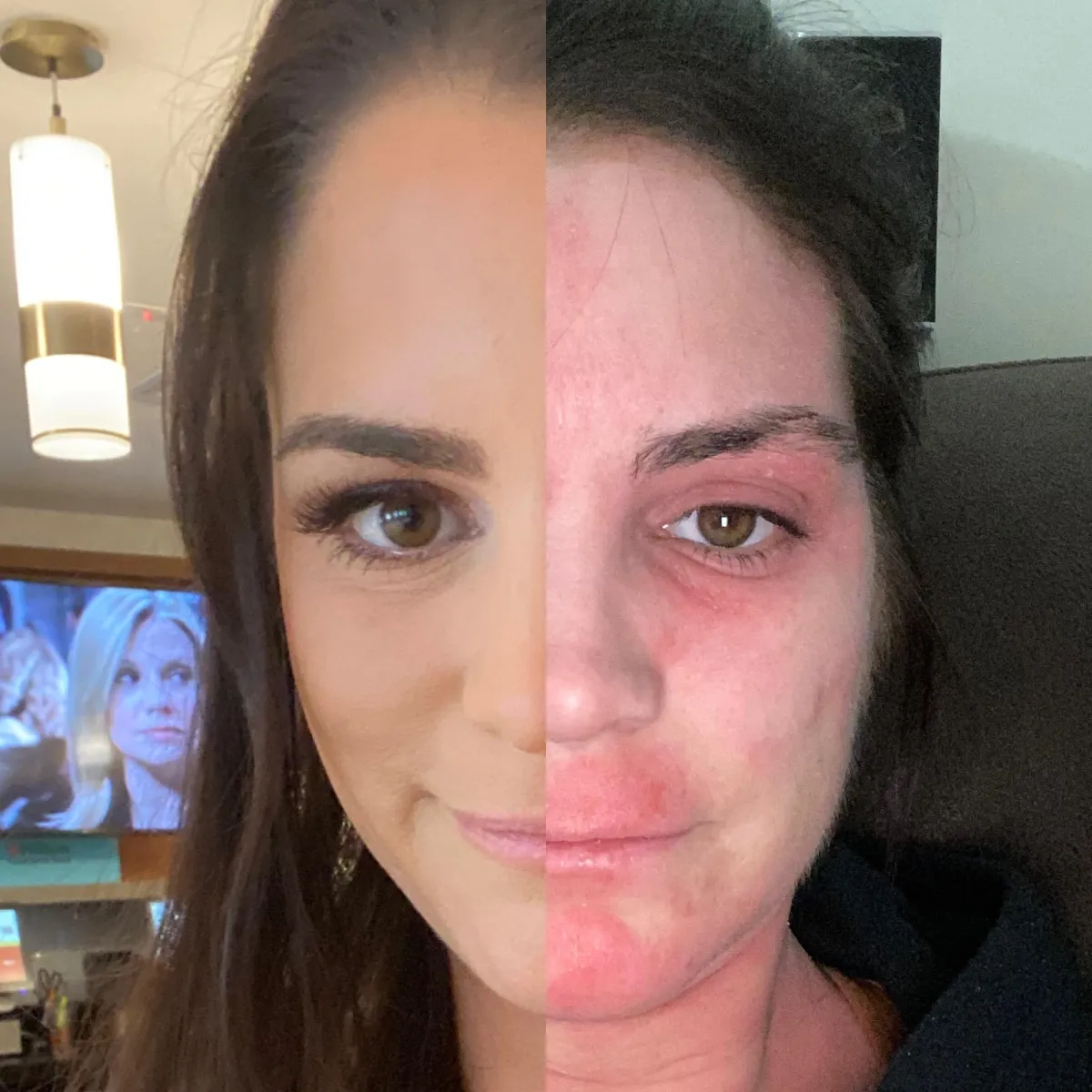 Topical Steroid Withdrawal