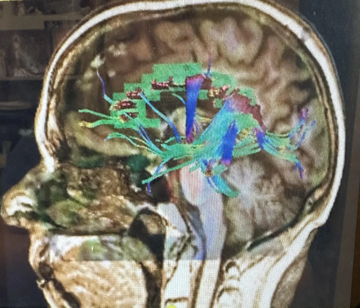 CTE