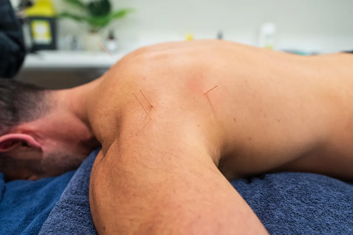 Curious About Acupuncture. Here Is What It Can Do For You.