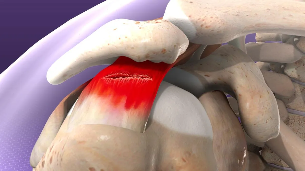 Rotator Cuff Injury