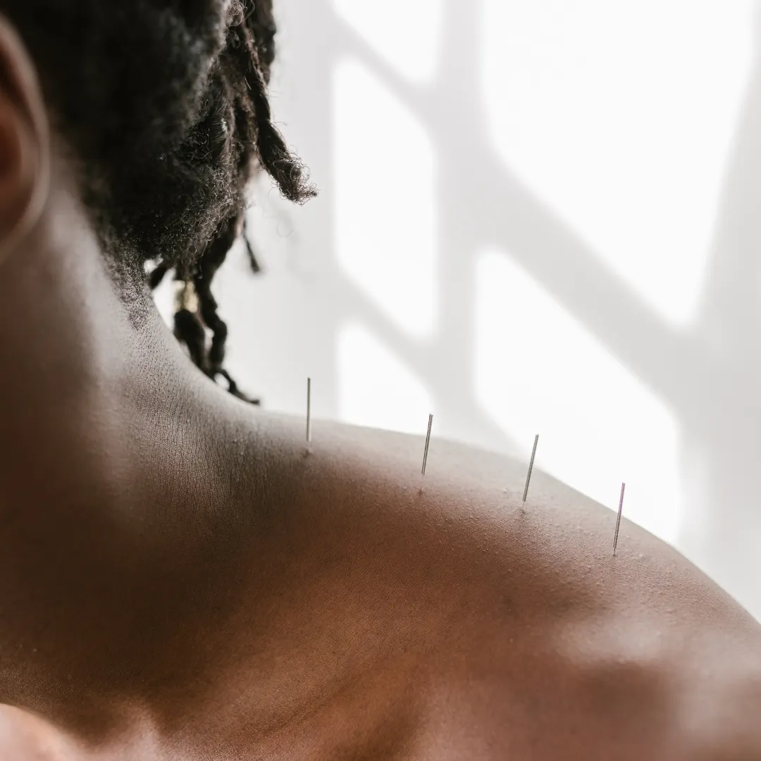 How Acupuncture Can Help With Insomnia