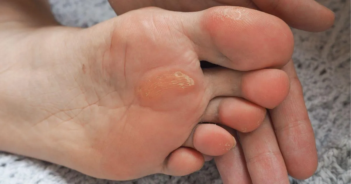 Corns and Calluses: How to Soften Your Feet
