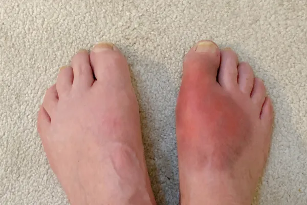 Gout in the Foot: What You Should Know About This Painful Problem