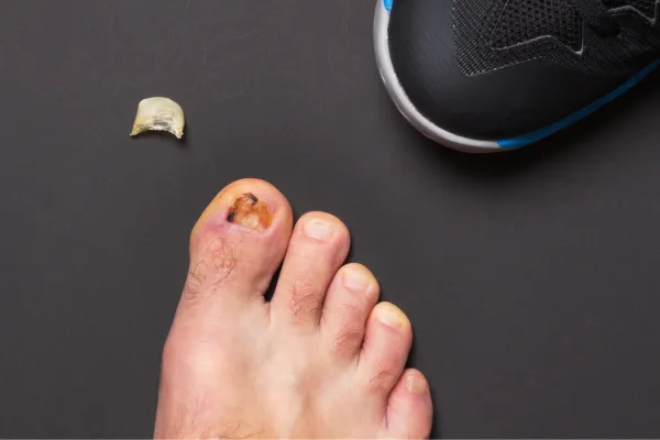 Toenail Injuries: How to Know If It’s Serious