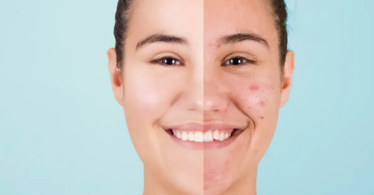Split-face comparison of a young woman showing clear, radiant skin on one side and acne breakouts on the other