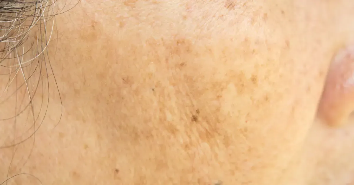 Effective Hyperpigmentation Treatments in Greenville, SC – Fade Dark Spots Naturally