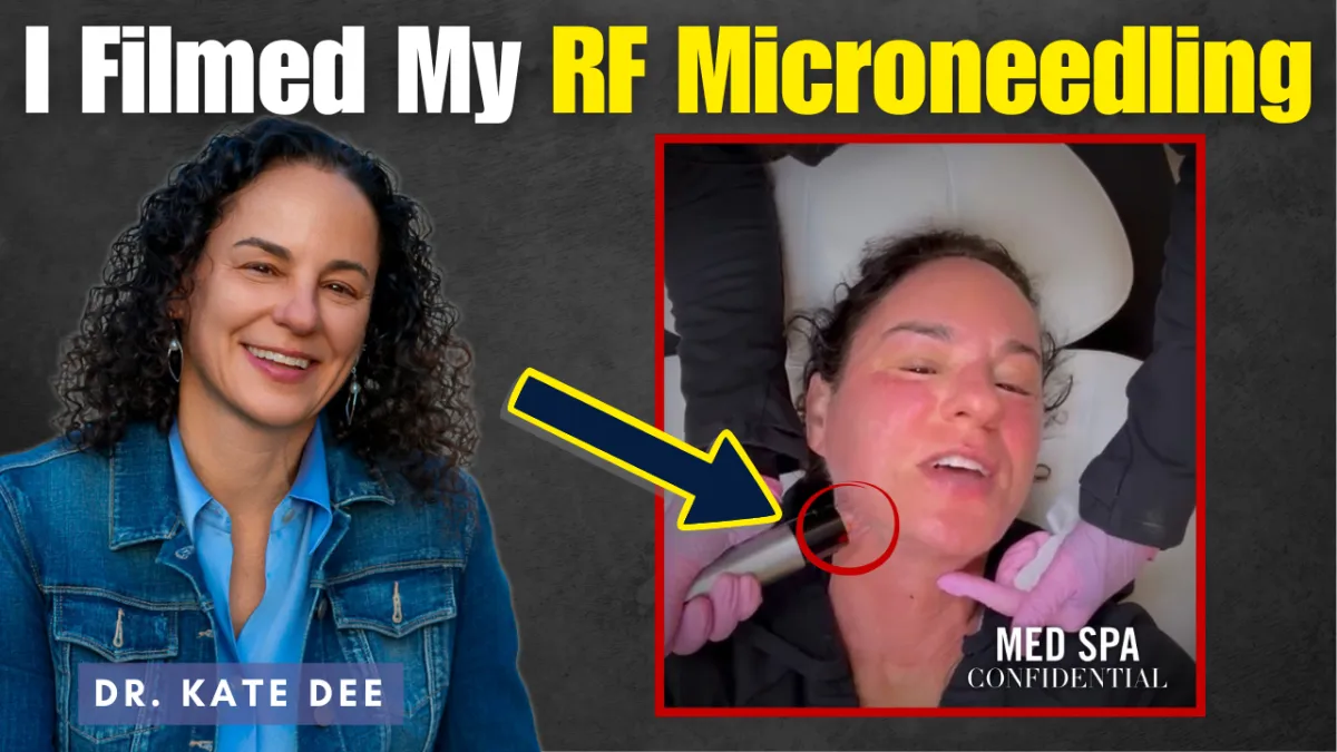 I Filmed My Entire RF Microneedling Treatment (Here's What They Don't Show You)