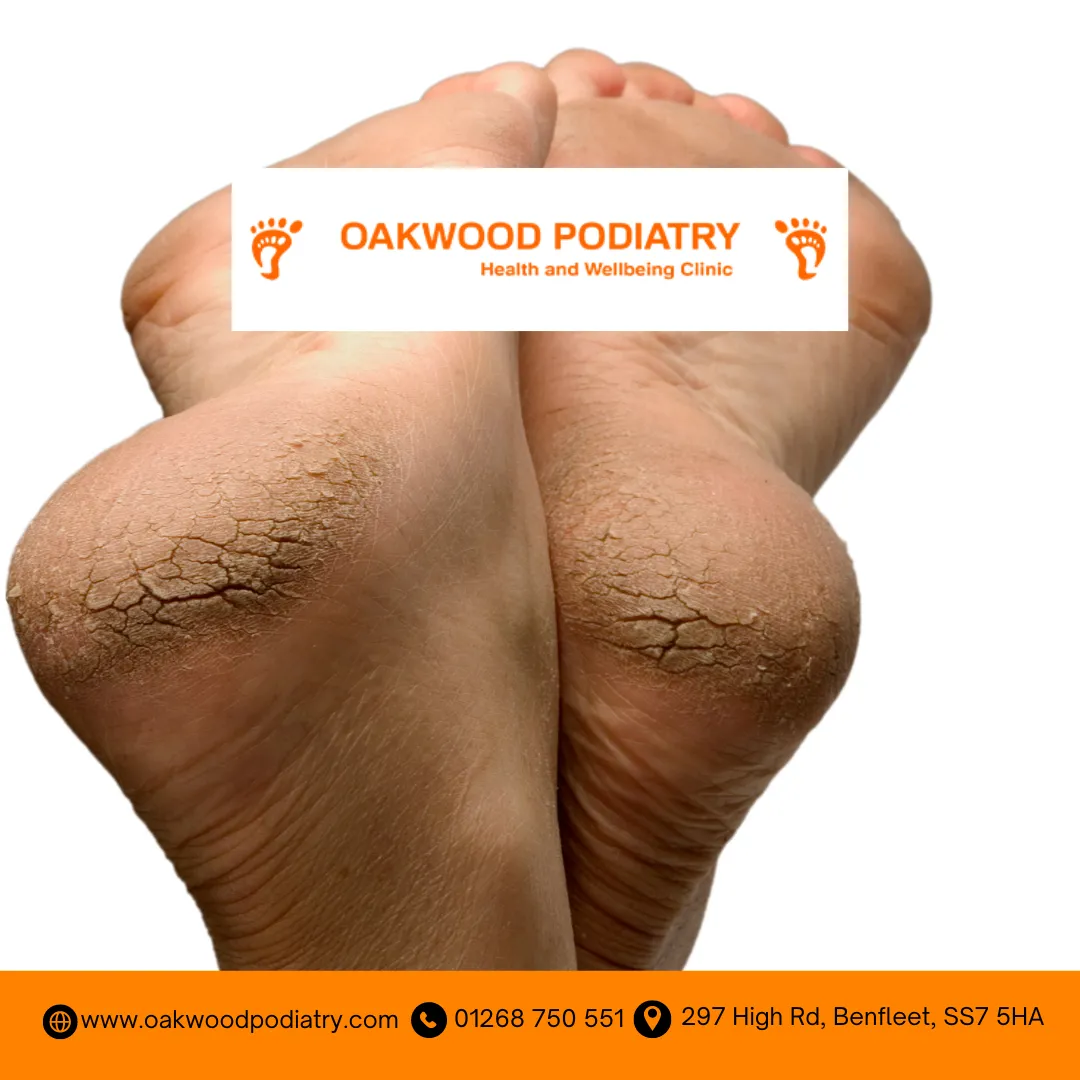 Caring for Dry, Cracked Heels