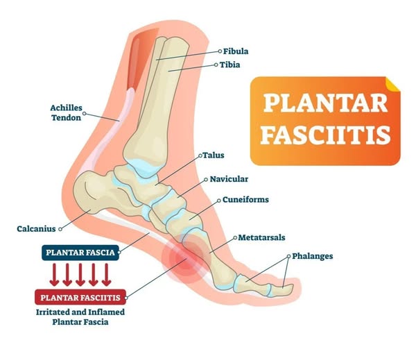 Is Your Foot Scripting a Tragedy? The Dramatic Turn from Plantar Fasciitis to Freedom with Shockwave Therapy!