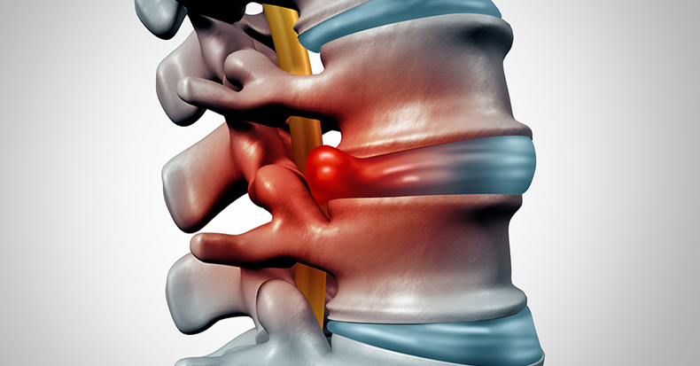Do Disc Bulges & Herniations Impact Daily Life (ADLs)—and Can Spinal Decompression (Cox® Technic) Help in Stuart, FL?