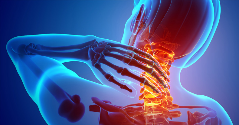 When Neck Pain Travels: Understanding Cervical Radiculopathy and Finding Relief in Stuart, FL